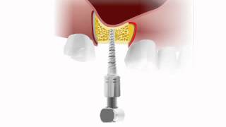 Bone Compression Kit  MIS Implants