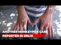 Third Monkeypox Case In Delhi 8 In India So Far Health Minister