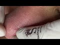 Nose Acne | Mụn Mũi - ThuyTruong#88