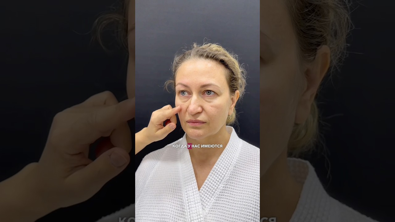 Плавание усугубило грыжи. Периорбитопластика 👀 Пластический хирург НИКОЛАЕВА САНДАРА