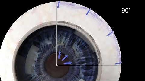 Ivantis Hydrus Microstent Product Overview Animation
