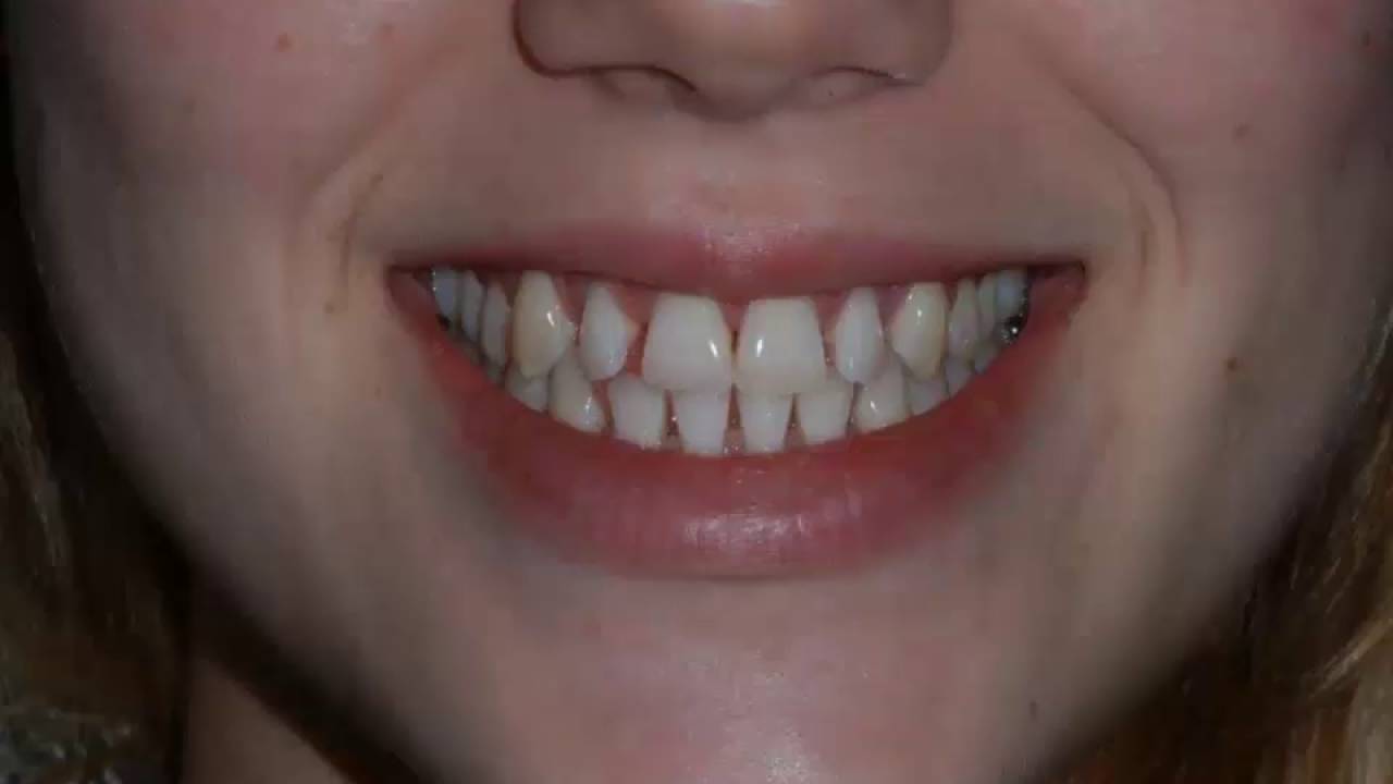 Best Cosmetic Dentist in Miami, North Miami Beach, Aventura Dr. Carroll on Dental Bonding