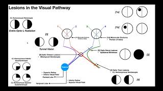 Lesions to the Visual Pathway EXPLAINED