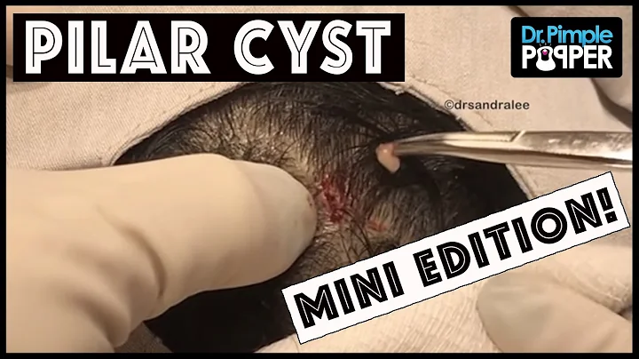 A Teeny Tiny Pilar Cyst Pop!