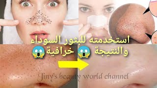Get rid of black and white pimples and dead cells on the face permanently 