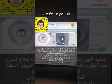 عمليه الليزر الدكتور حسن البحراني المركز الامريكي للعيون و الشبكيه اربيل