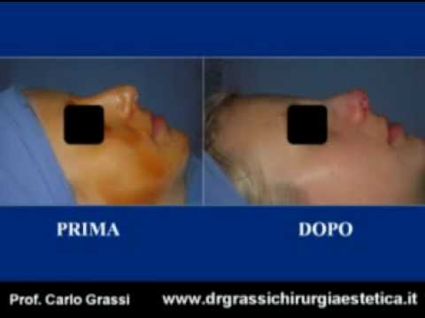Rinoplastica Video Chirurgia Estetica Naso Fotoritocco Youtube