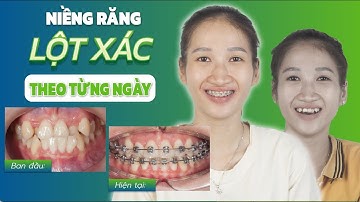 Niềng Răng Đã Thay Đổi Nụ Cười Của Mình Như Thế Nào?
