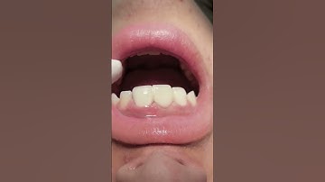 Zirconia bridge to replace missing teeth #dentist