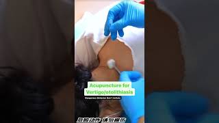 Acupuncture for Vertigo/otolithiasis #acutcmschool #acupuncturetraining #szenanphua #Vertigo