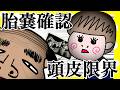 胎嚢確認で先生の頭皮が限界【アニメ】【夫婦】