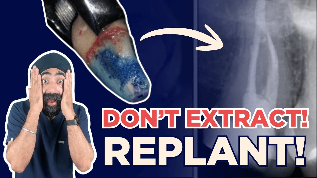 Before You Extract: Intentional Replantation in Practice - PDP256