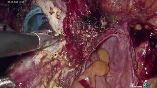 TLH IN ACUTELY VENTROFLEXED UTERUS IN PREVIOUS LSCS AND HISTORY OF OPEN MYOMECTOMY