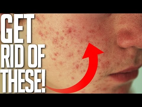 Video: ❶ How To Get Rid Of Red Spots On The Face