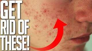 I'm using this for my redness/scar routine now:
http://bit.ly/brianbanishmy other social media & clothing brand:???
instagram: http://www.instagram.com/thickso...