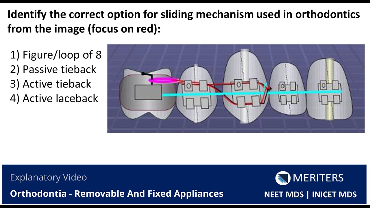NEET MDS, INICET - Orthodontia - Removable And Fixed Appliances, Explanatory Video