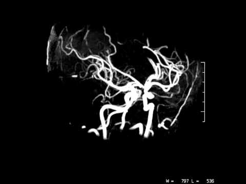 Mav Full Form In Medical Brain