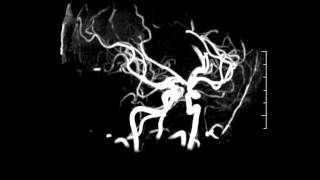 3D Tof Mra Of The Brain