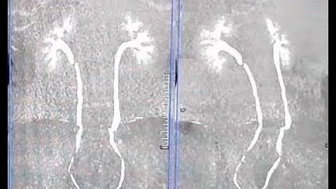 CT Urogram syngo via processing