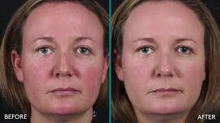 Introducing Colorescience All Calm Clinical Redness Corrector SPF 50