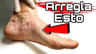 Los MEJORES Ejercicios para ELIMINAR las VARICES