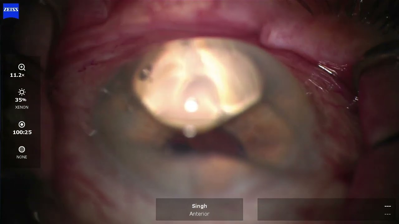 Streamline Canaloplasty and Goniotomy - I Paul Singh, MD