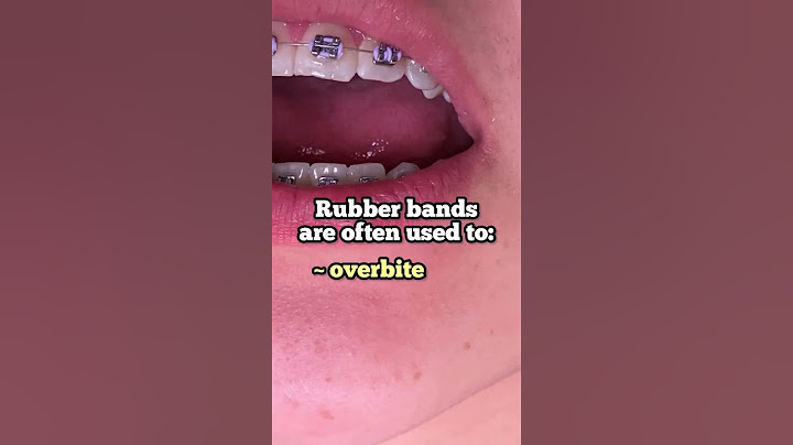 Why Use Rubber Bands With Braces? Toothtime Family Dentistry New Braunfels  #braces #dentaltreatment
