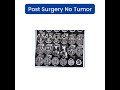 Dr. Manthan Patel | Neurosurgeon in Ahmedabad | Vaishvi Brain & Spine Hospital | Deep Brain Tumor