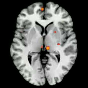 Brain activity while listening to familiar music (meta-analysis)