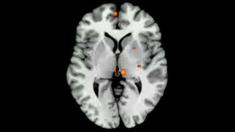 Brain activity while listening to familiar music (meta-analysis)