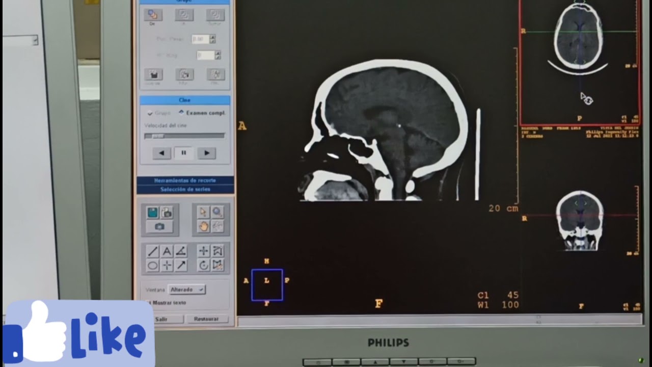 cómo reconstruir una tomografía de cráneo simple, en corte axial, coronal, sagital y 3D.