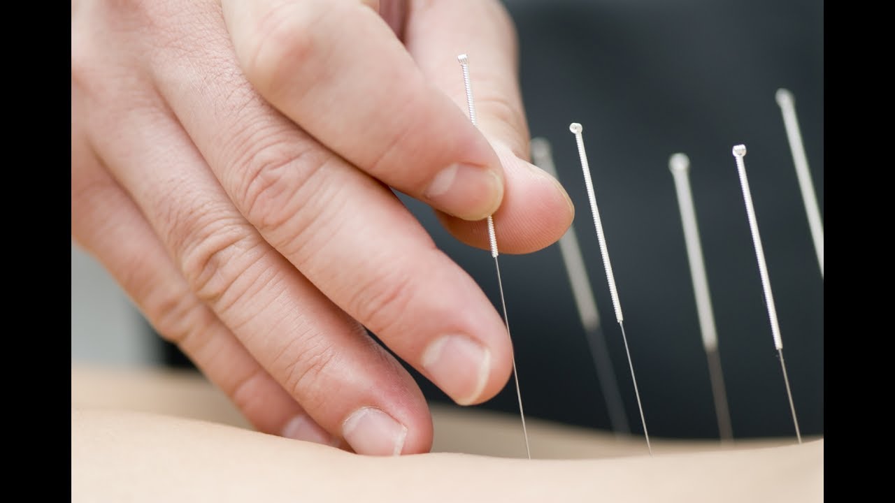 Dry Needling / Agulhamento Seco (Trigger Points) Clínica de