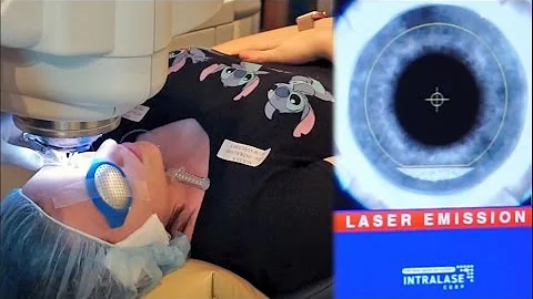 I GOT LASIK DONE! LasikPlus for Astigmatism- Does it Work/Worth it??