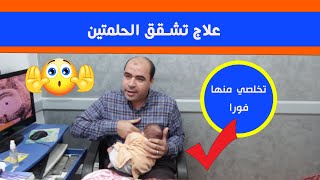 تشقق الحلمتين بعد الولادة ✅👌 تخلصي منها فورا بهذه الطريقة