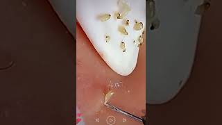 Skincare | Blackheads Removal #827 #tweezers skincare #blackheads blackheads