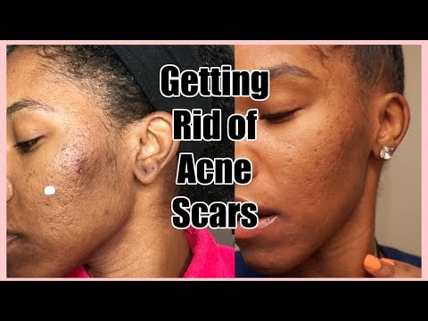 How to get rid of acne scars | Skin Vlog #3