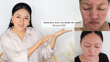 What foods make rosacea worse?