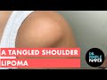 A Tangled Shoulder Lipoma