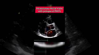 Myxomatous Mitral Valve with Prolapse of PMVL #echocardiography #heart