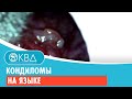 Кондиломы на языке. Клинический случай №6