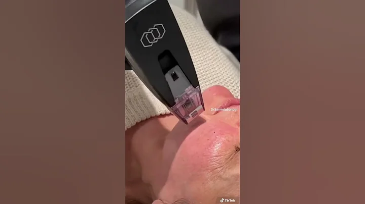 Morpheus8 Skin Tightening Treatment | Sunder Plastic Surgery | #shorts