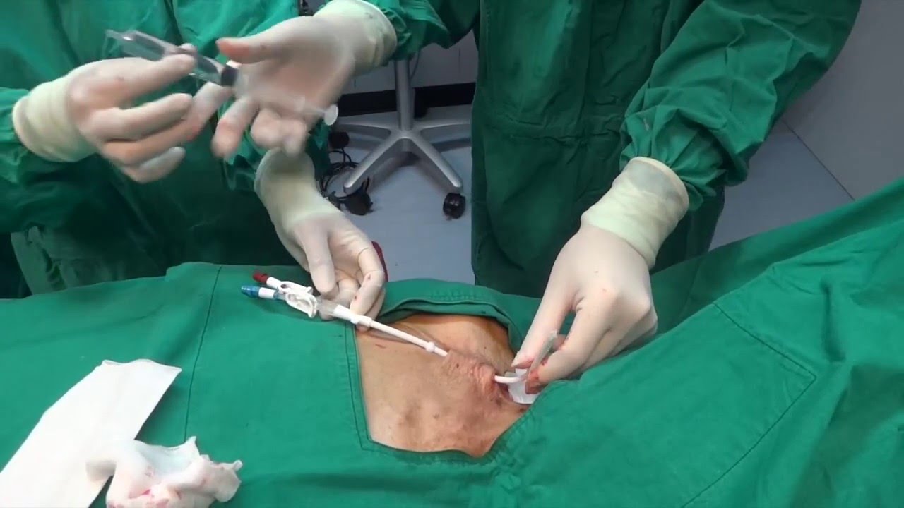 Palindrome Catheter Insertion Rt Subclavian V Supraclavicular Palindrome Catheter Insertion Rt Subclavian V Supraclavicular