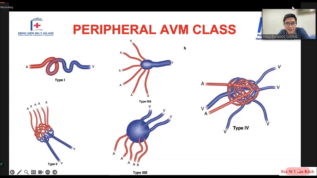 Endovascular Treatment of Brain AVM