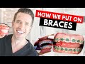 How Braces are Put On | Part IV| Dr. Nate