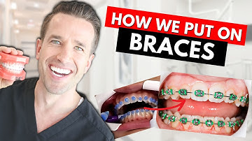 How Braces are Put On | Part IV| Dr. Nate