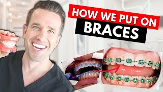 How Braces are Put On | Part IV| Dr. Nate