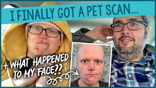 I Finally Got A PET Scan... Results + What Happened To My Face?! ‍♀