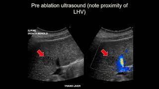 Image guided tumor ablation