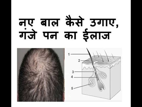 Hair Care Tips Grow Your Front Hair Fast With These Easy Home Remedies in  Hindi  कय समन क बल झडन स आपक खपड भ नजर आन लग खल जन  समन क