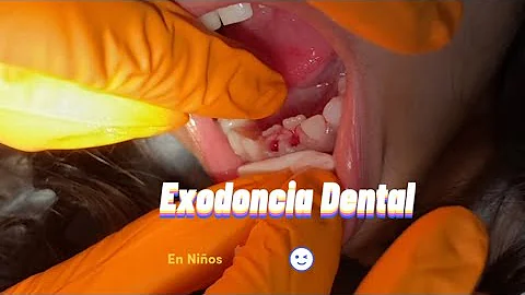 ¿Cómo extraen los dentistas los dientes que se han roto?